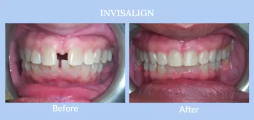 invisalign-before-and-after