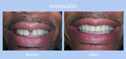 invisalign-close-up-before-and-after-1