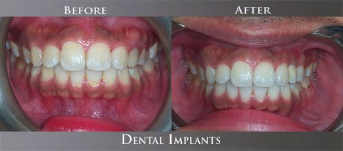 implant01 (1)
