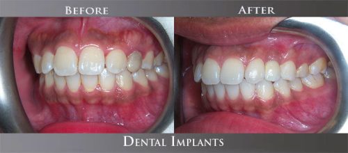 implant02 (1)