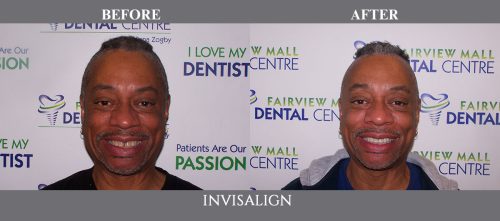invisalign01 (1)