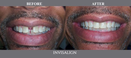 invisalign02 (1)