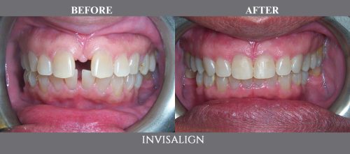 invisalign03 (1)