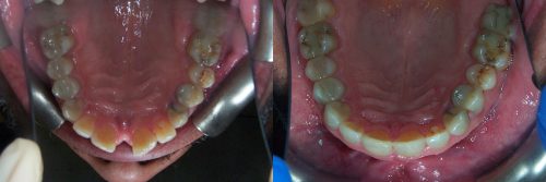 invisalign04