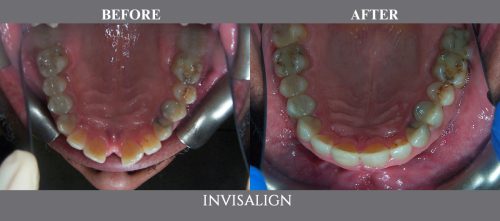 invisalign04 (1)
