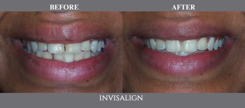 invisalign05 (1)