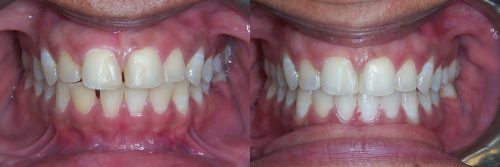 invisalign06