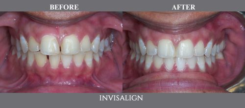 invisalign06 (1)