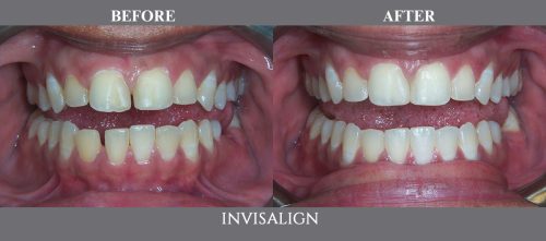 invisalign07 (1)
