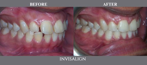 invisalign08 (1)