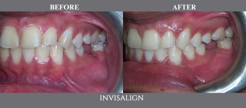 invisalign09 (1)