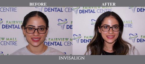 invisalign10 (1)