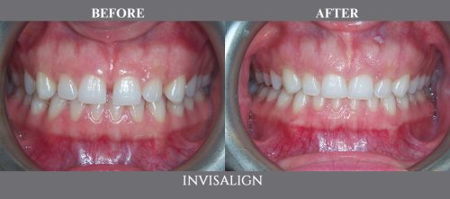 invisalign11 (1)