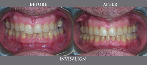 invisalign12 (1)