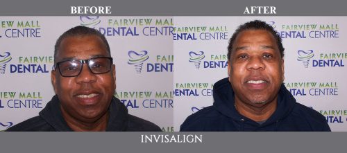 invisalign13 (1)