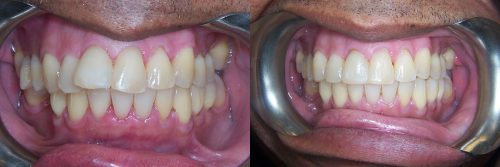 invisalign14
