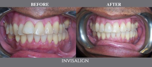 invisalign14 (1)