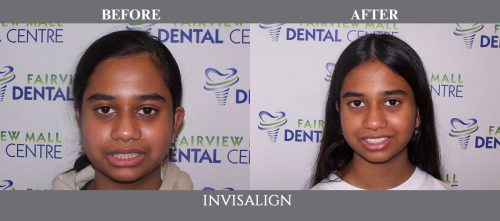 invisalign15 (1)