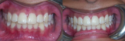 invisalign16