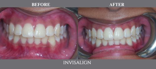 invisalign16 (1)