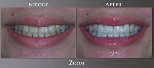 zoom-before-after