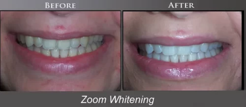 zoomwhietning